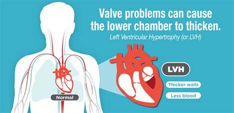 what causes lvh